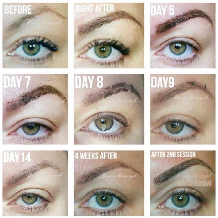 Saline Eyebrow Tattoo Removal Before and After When Is It Better
