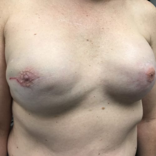 Scar Revision & Nipple Tattoo