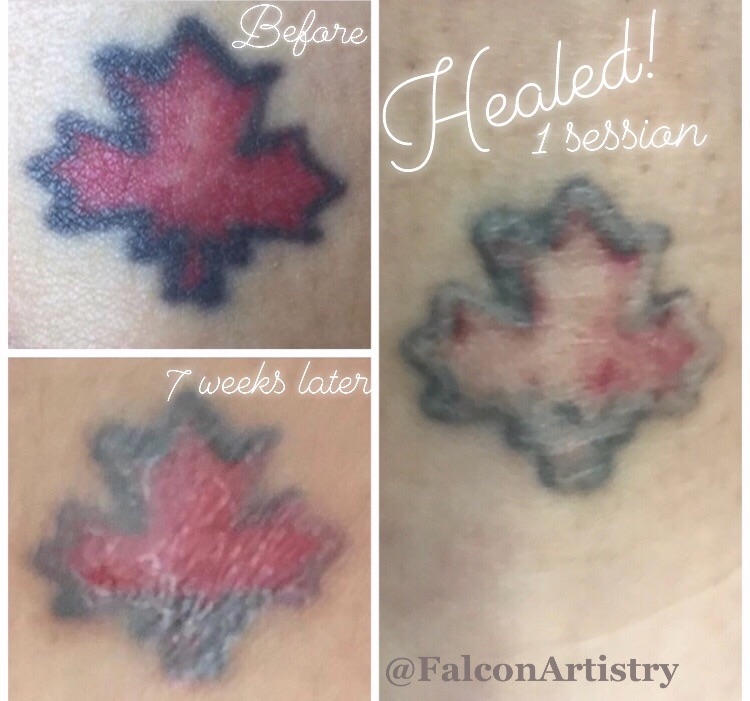 Tattoo Removal and Lightening  About Face and Body