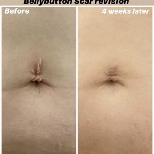 bellybutton-scarreduction