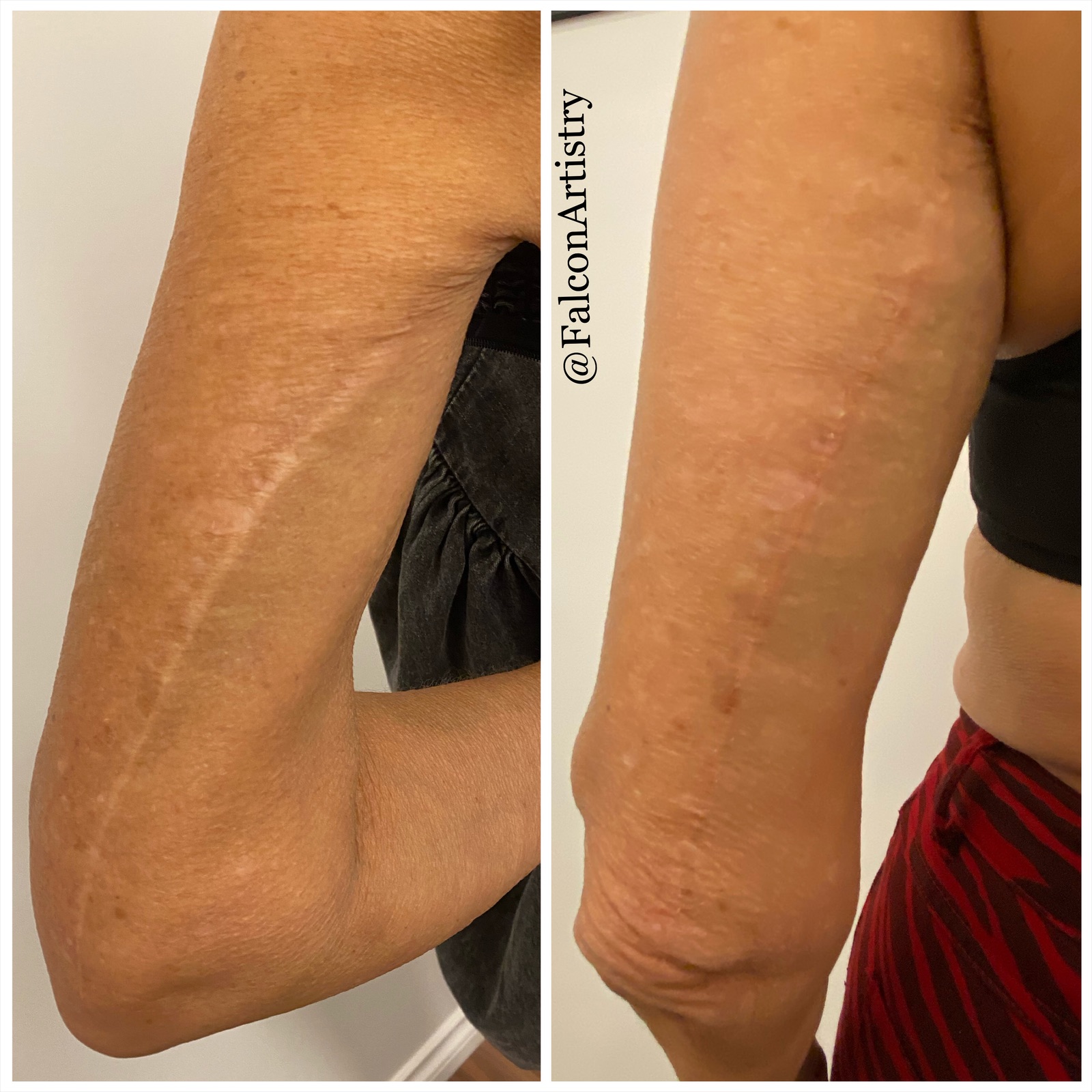 Pink Ink Tattoo - Scar camouflage tattooing- A scar is a mark left on the  skin after trauma. When your skin is injured, your body produces collagen  to reconnect the broken tissues,