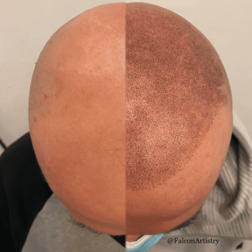 full-scalp