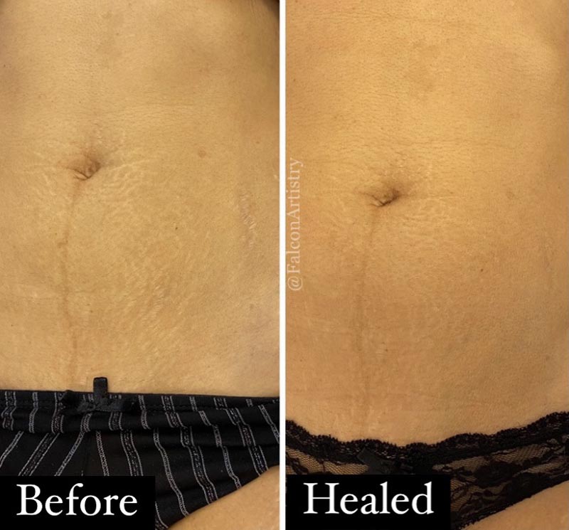 stretch mark tattoo camouflage before and after