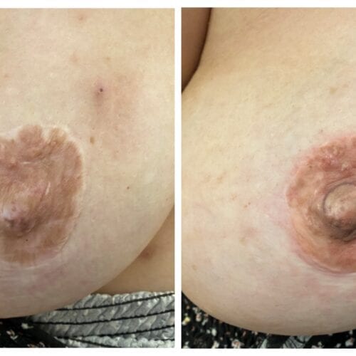Nipple Pigmentation
