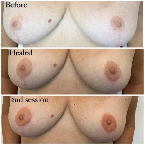 Nipple Pigmentation breastred-tattoo